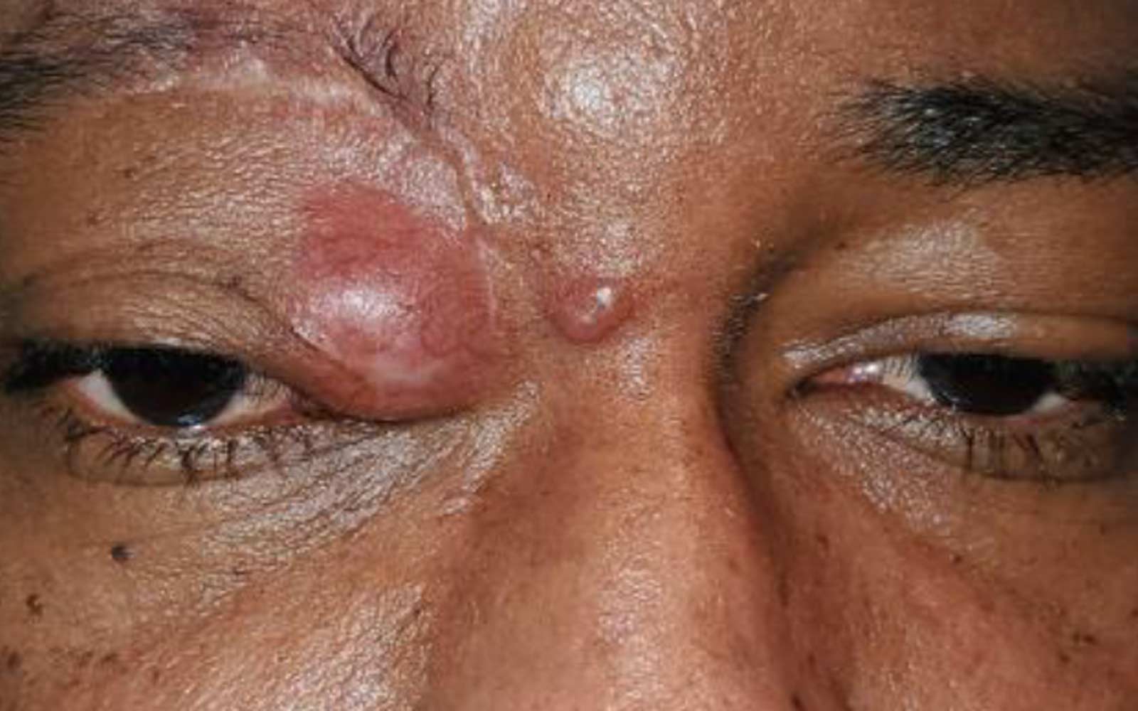 Neurofibroma fronto nasoorbitario: Reporte de un caso